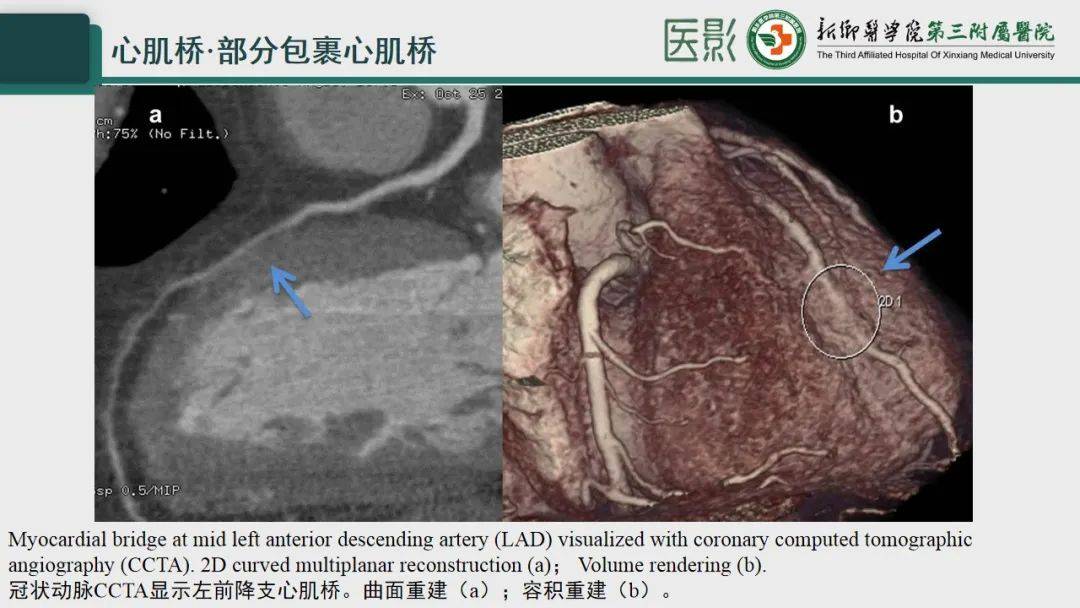 冠脉cta—心肌桥诊断要点