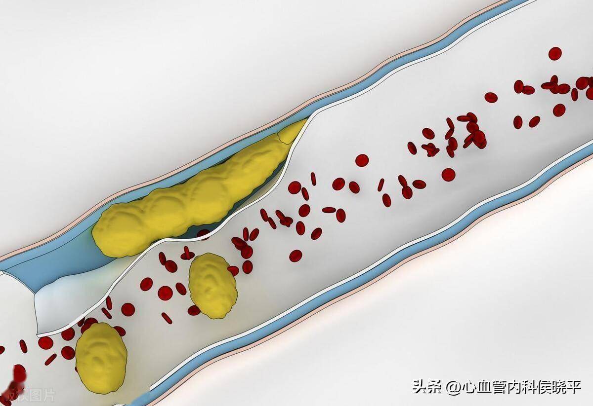 动脉粥样硬化斑块是怎样长成的?