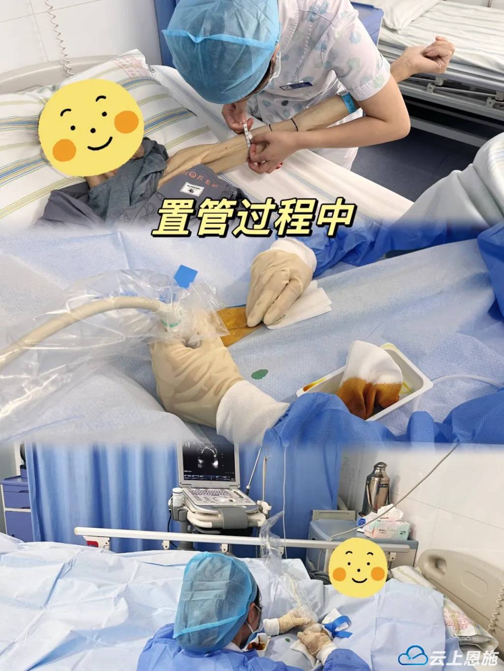 捣管手法
