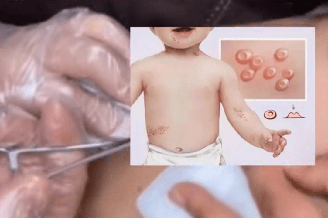 害怕!去了趟水上乐园,脸上长满"小肉粒"