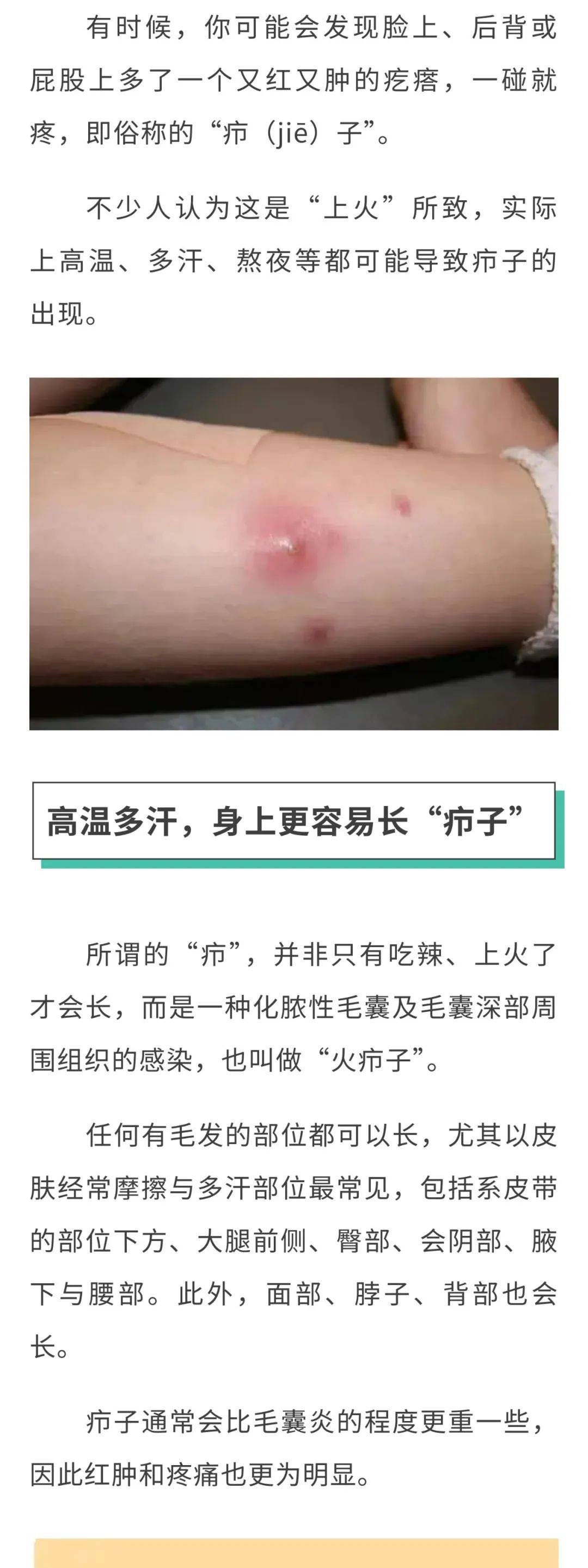 "长疖子"是上火了吗?