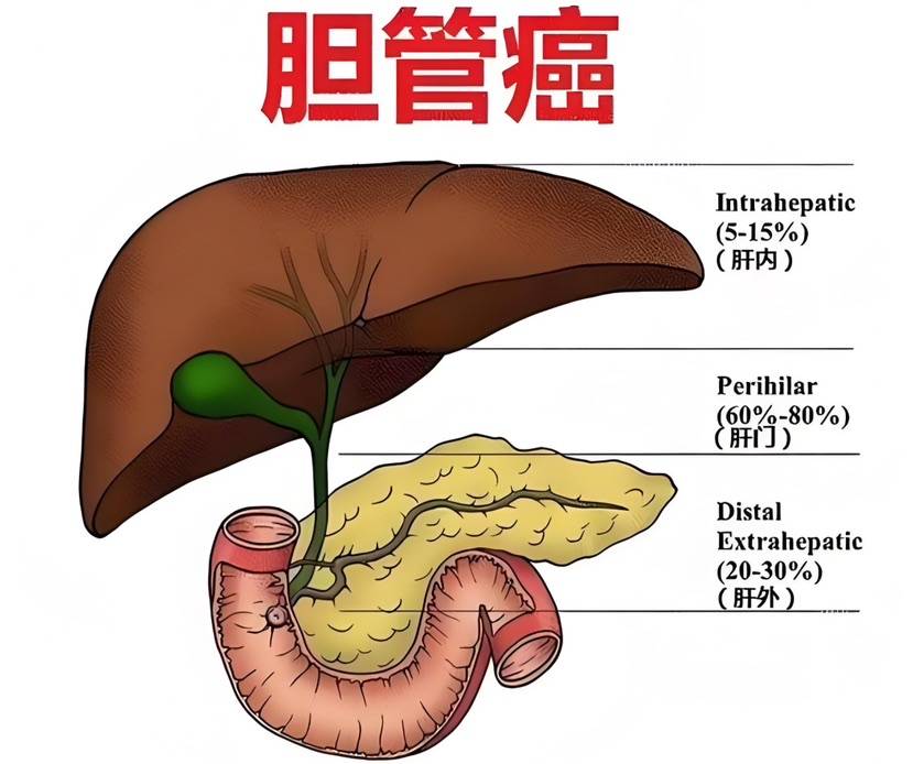 胆管癌的位置图片图片