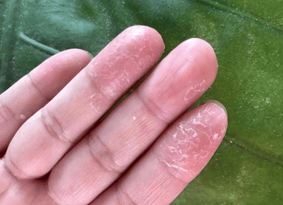 过敏反应:某些洗洁精中的防腐剂和香料是常见的过敏原,可能引发皮肤