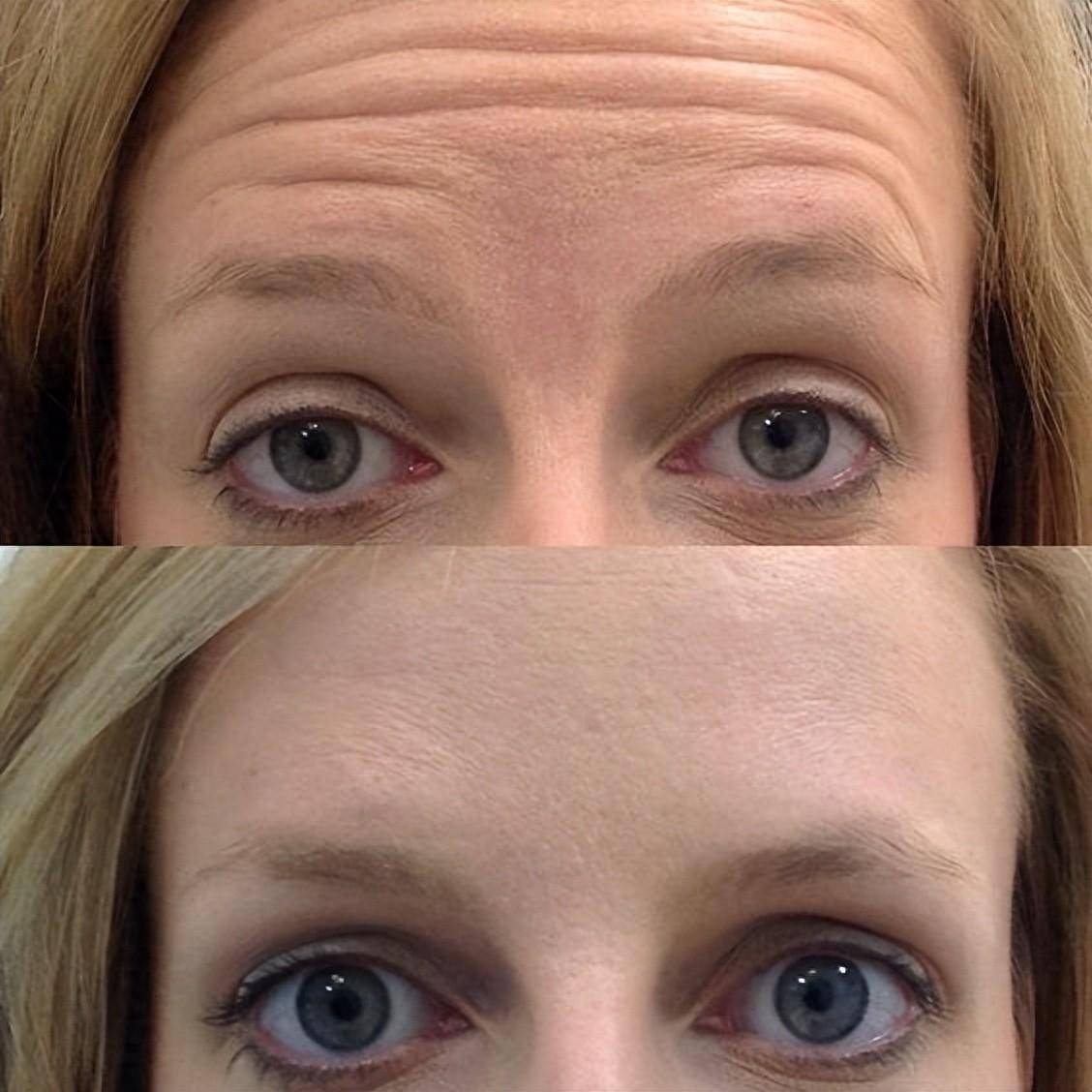 抬头纹!抬头纹!消除"岁月痕迹",就靠这2招!