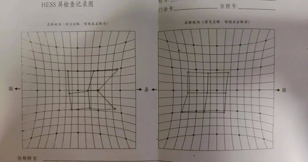 自己斜视测试图 轻微图片