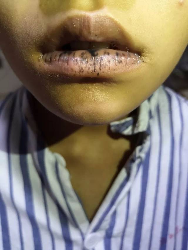 孩子嘴唇长"黑斑"千万别忽视!可能"肠子"有大问题