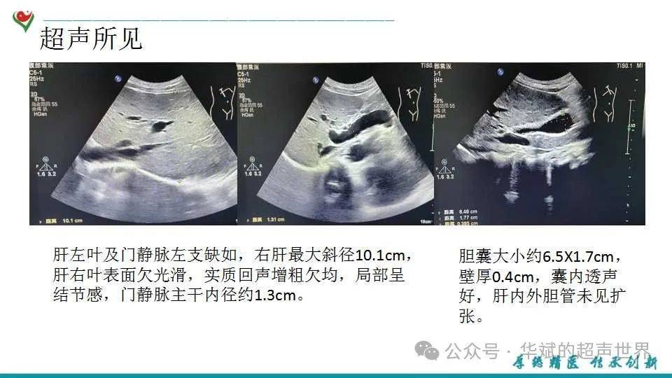 肝右叶斜径图片