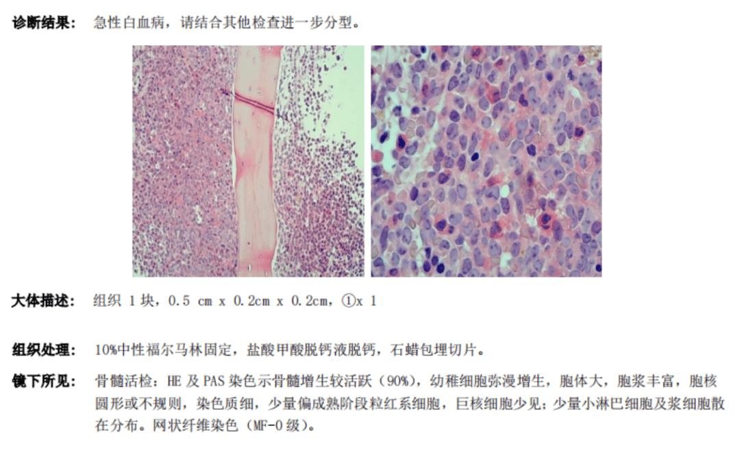 骨髓活检骨髓流式骨髓形态报告dce染色mpo染色骨髓细胞形态外周血细胞