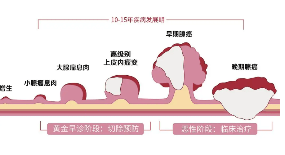 耵聍腺癌图片