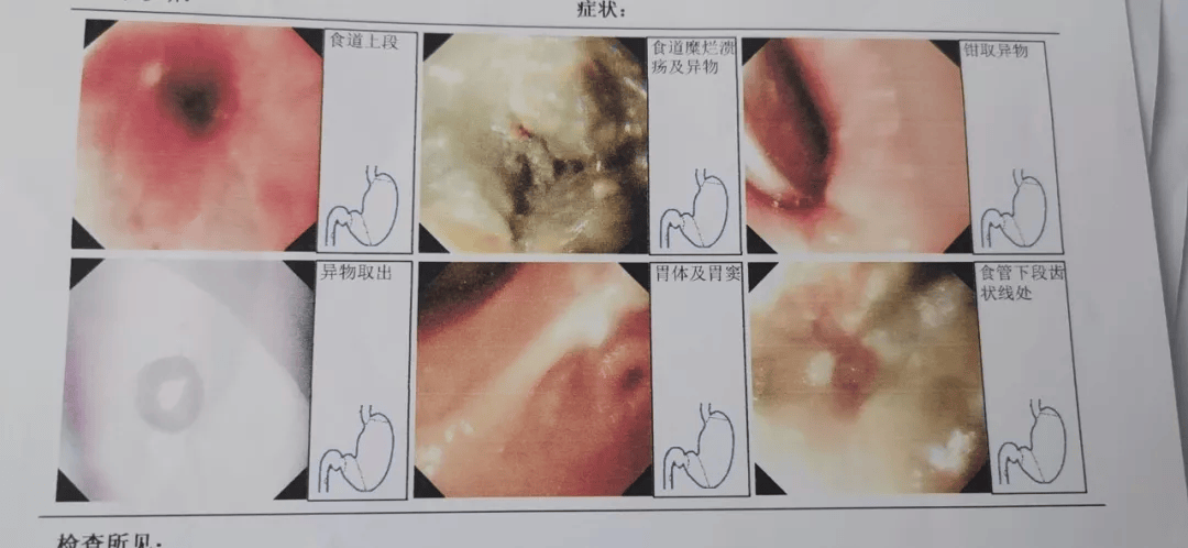 儿童吞食异物怎么破?