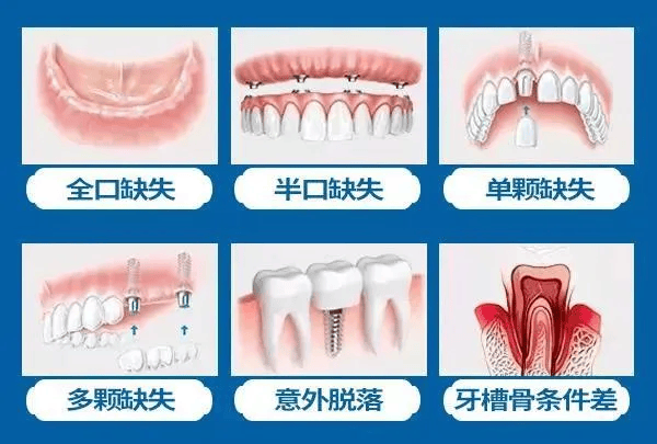 牙齿象限的划分图图片