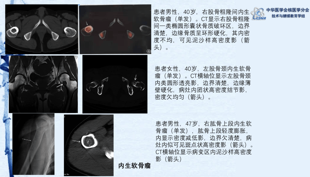 【继教】肖茜,侯莎莎:常见良性骨肿瘤的spect/ct表现