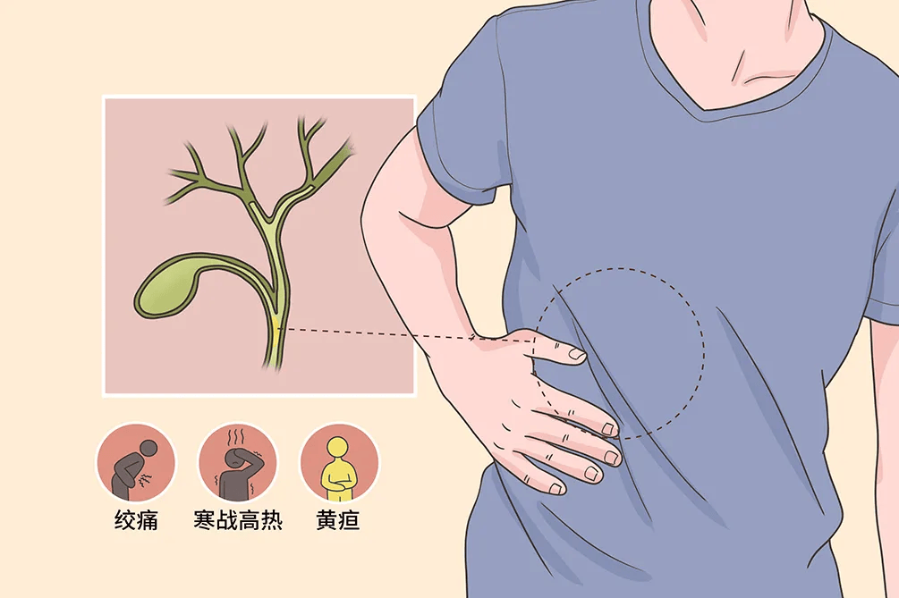 市中医医院成功完成腹腔镜下胆囊切除及胆总管内巨大结石碎石取