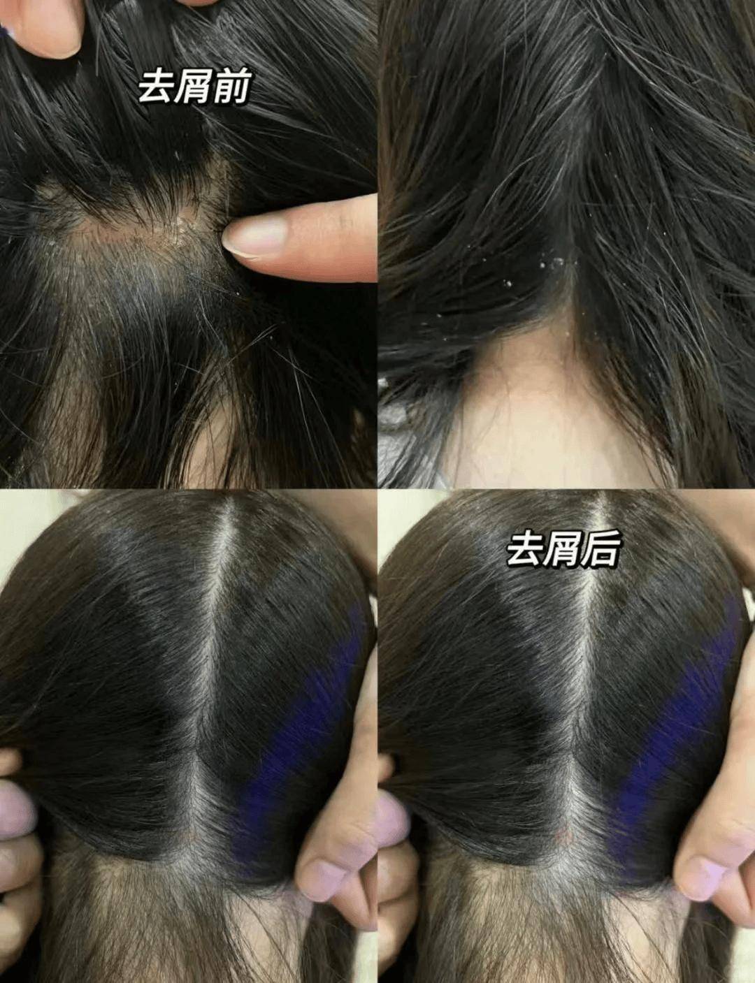 是不是每个人都能从头皮里抠下来硬硬的结痂啊?