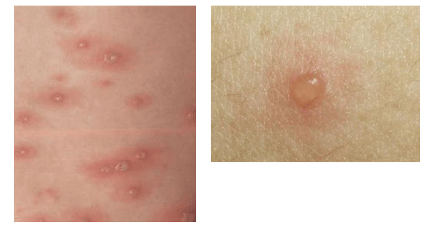 我市7-12岁儿童可免费接种水痘疫苗啦!