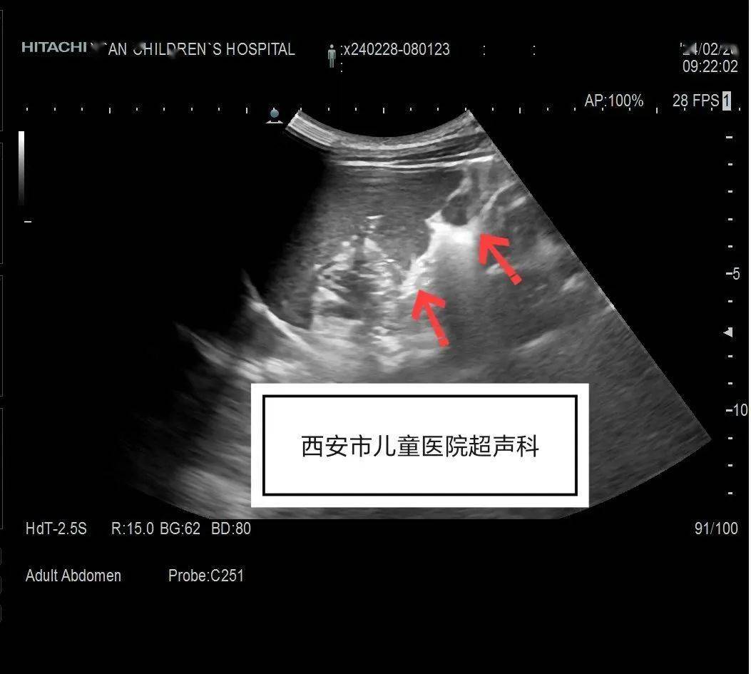 超声_治疗_脾脏