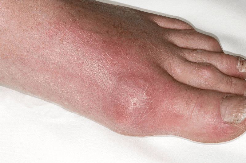 今年4月初,杭州14岁的初中生小木(化名),在吃完火锅后,大脚趾突然剧烈