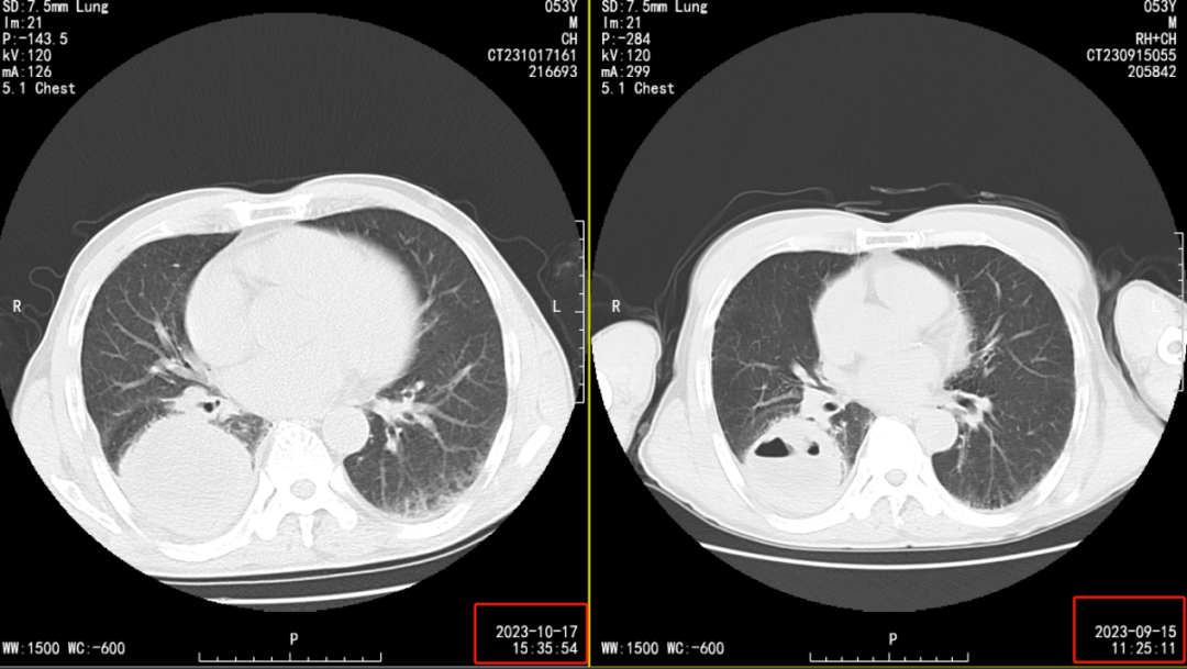让人匪夷所思的「肺脓肿」,并非你所想_病灶_影像_复查