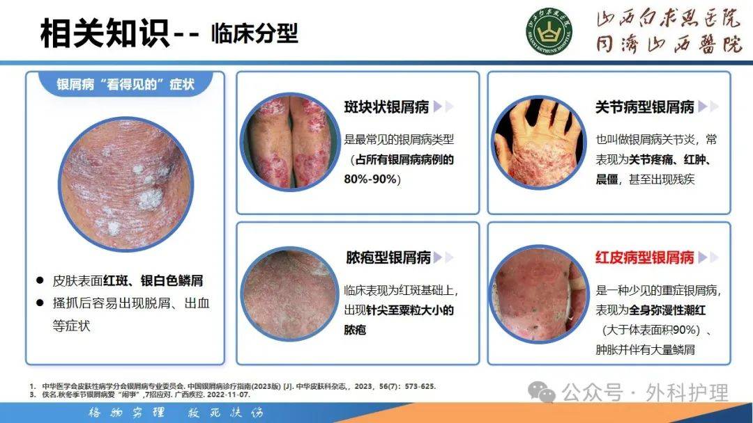 银屑病专科：破解皮肤难题的新篇
