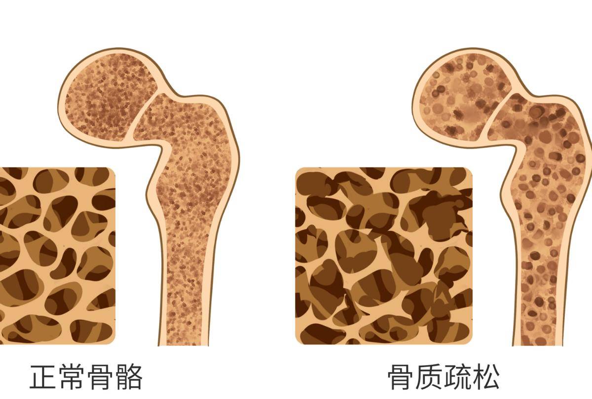 52岁女子吃维生素d预防骨质疏松