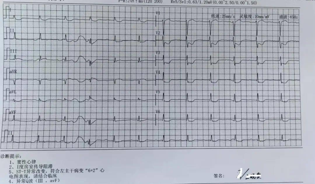 心电图8+2现象诊断标准图片