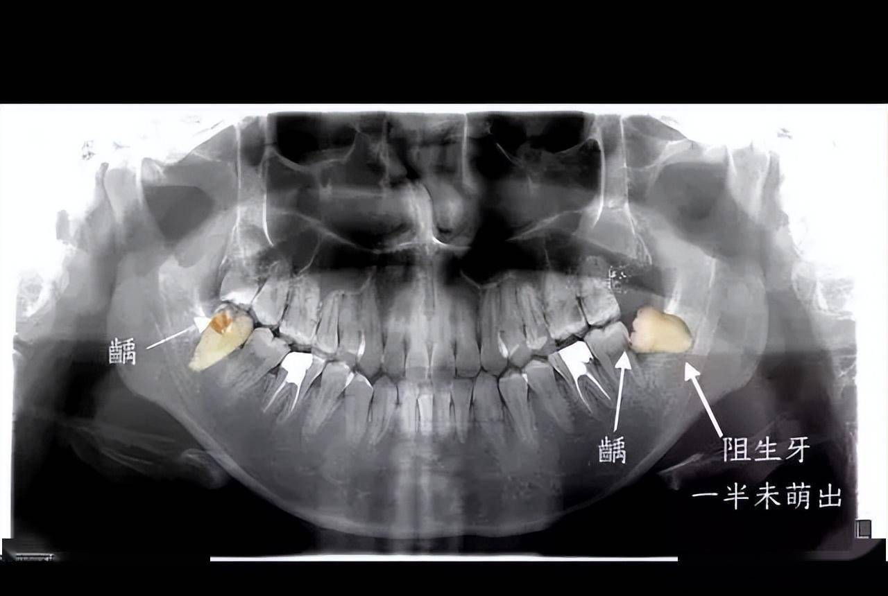 智齿是哪一颗牙齿图图片