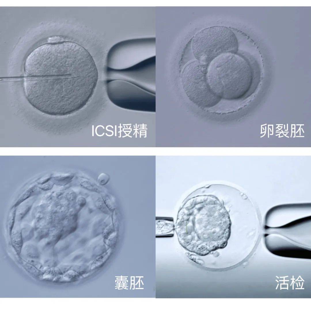 "地贫"夫妻伤不起 第三代试管婴儿技术打破"遗传病魔咒"