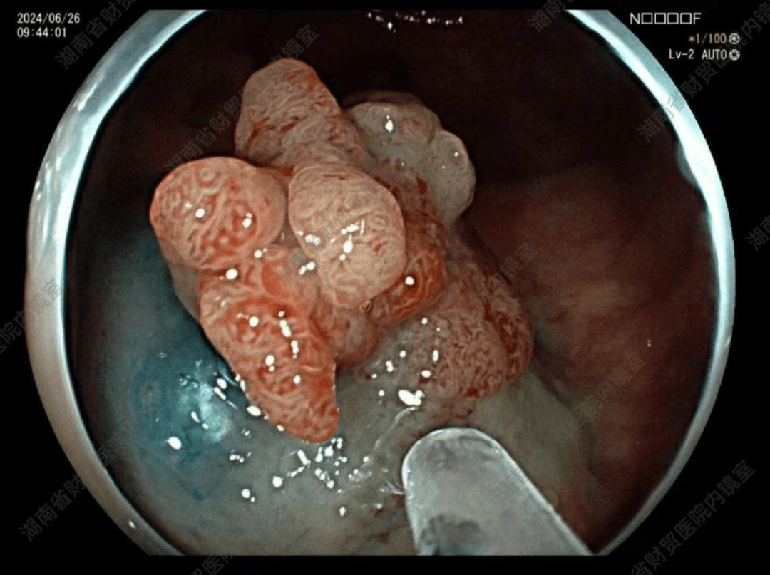 2乙状结肠:绒毛管状腺瘤,局灶腺体高级别异型增生,蒂部切缘未见病变