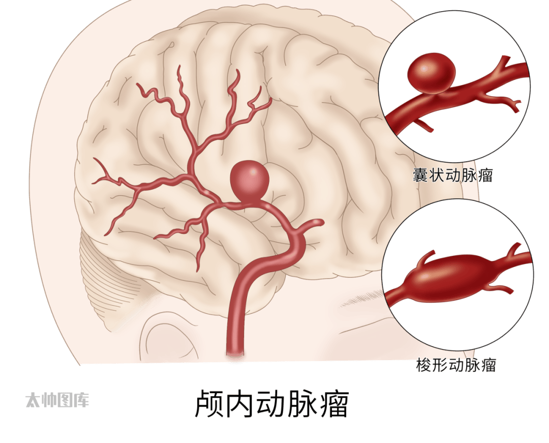 脑动脉瘤介入治疗图解图片