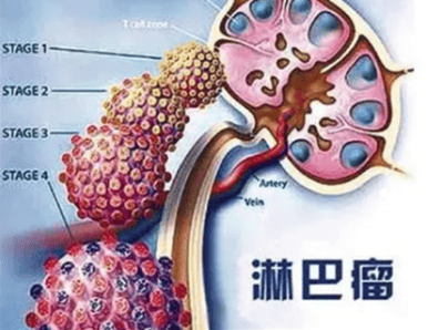 科普 | 9·15是第21个世界淋巴瘤日，关注会“跑”的肿瘤——淋巴瘤(图1)