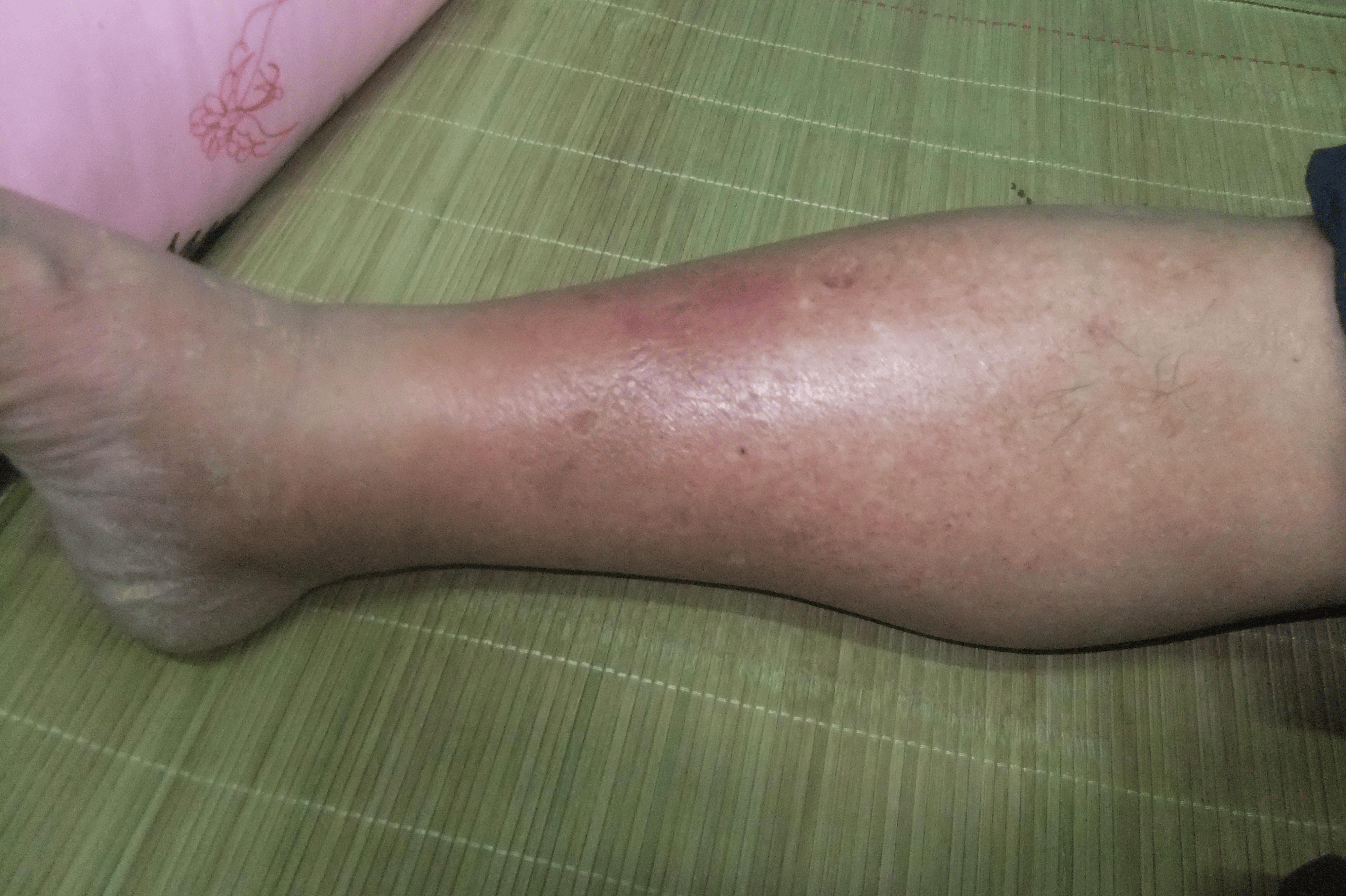 男子脚后跟发麻一个月查出肝癌,脚有3种异常,或是重大疾病信号