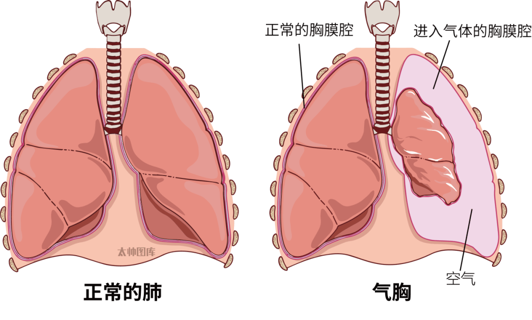 开放性气胸示意图图片