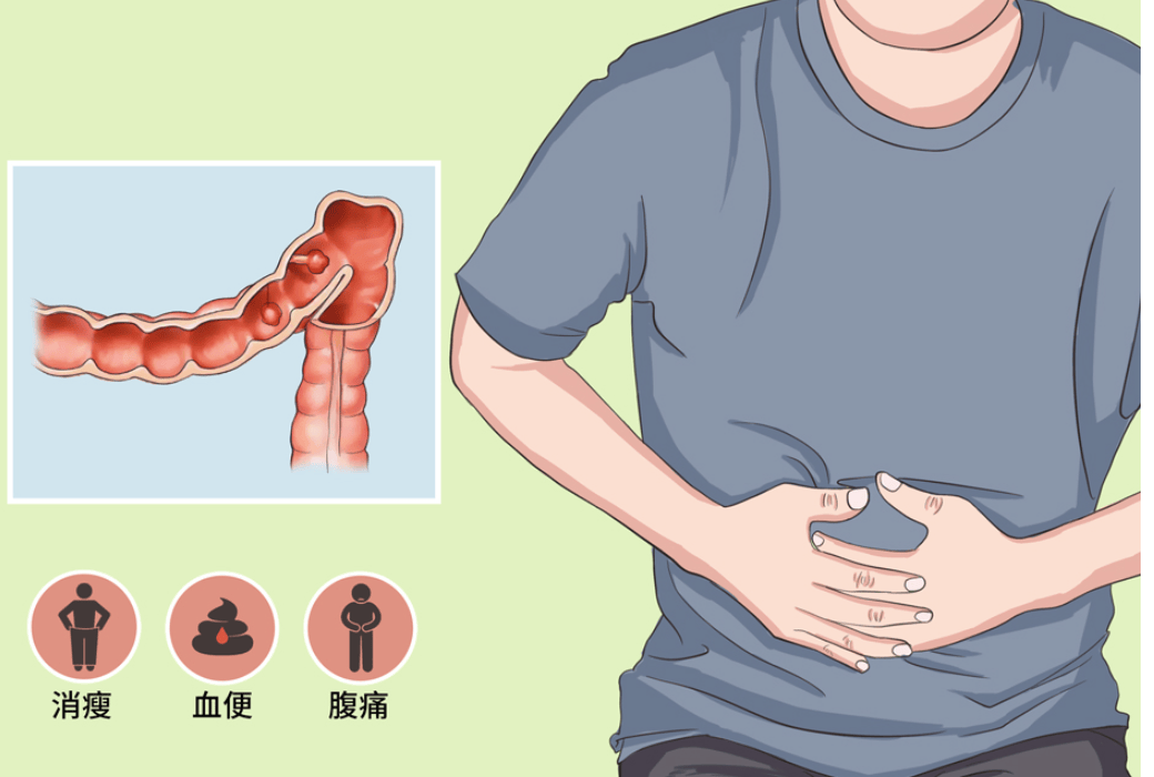 "肠"治久安 | 沭阳医院普外科成功开展腹腔镜下乙状结肠切除术