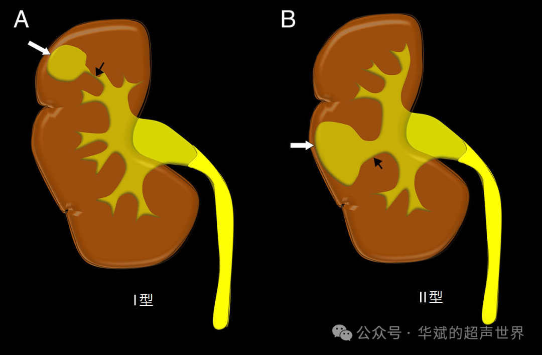 造影_肾盂_病变