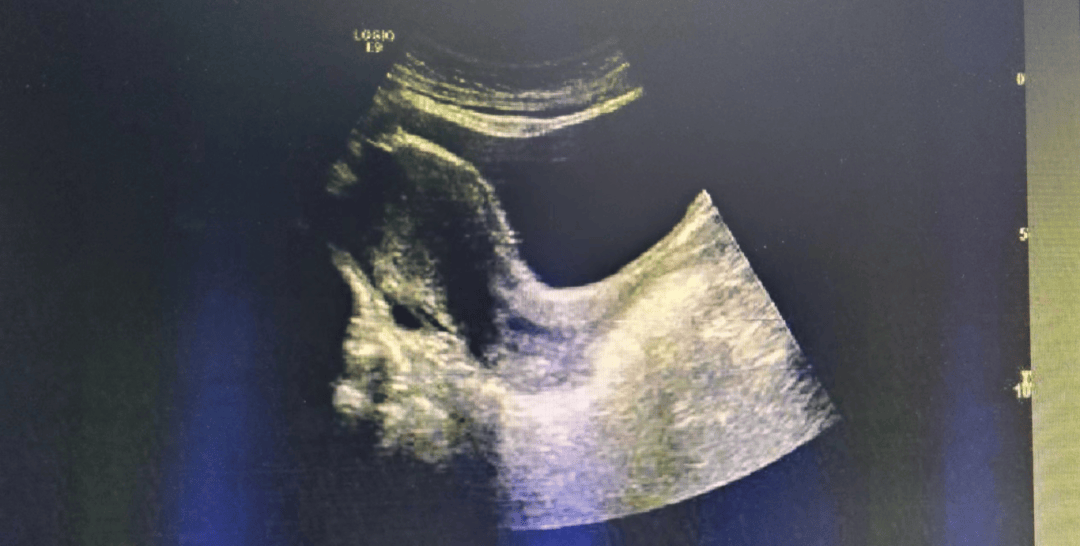 像打开了窗户一样,让超声波畅通无阻的穿过,直接到达子宫和卵巢,所以