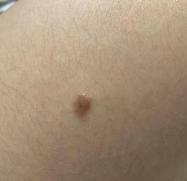 腋窝下为何会长出"小肉粒"?医生:多半与这些因素有关,需重视