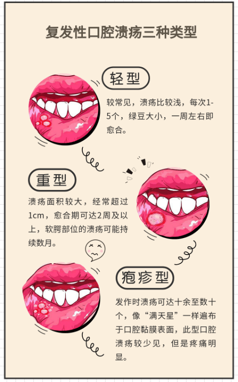 被口腔溃疡反复折磨的年轻人,除了忍,还能做什么?