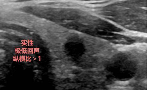 甲状腺结节超声图像图片