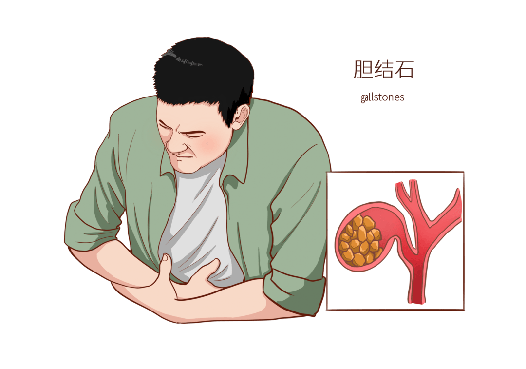 胆囊结石,超声表现是这样的.