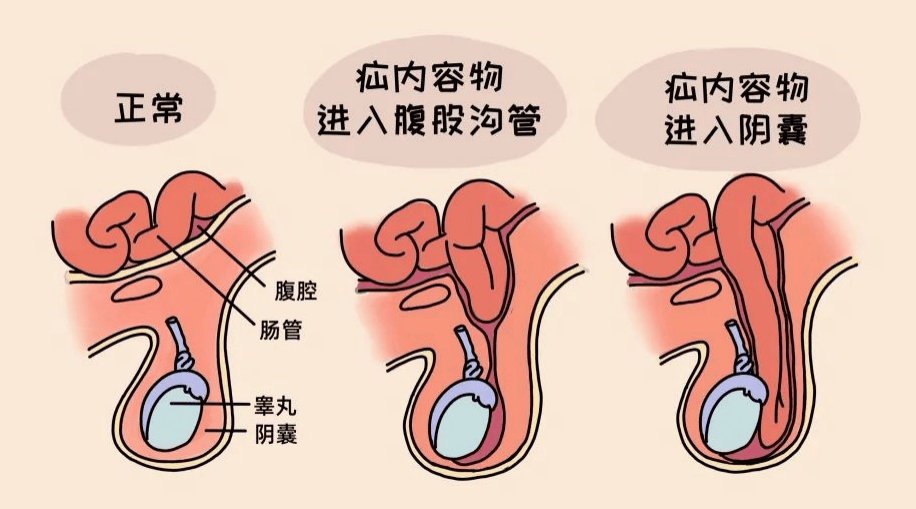 通俗地讲