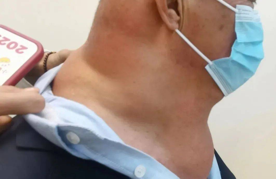 近年来 辉哥的脖子变得异常粗壮 几乎和肩膀融为一体 脖子后方还肿出大包