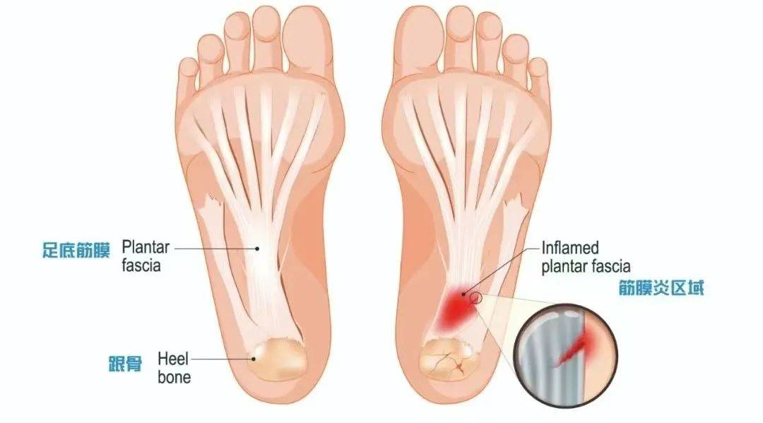 足底筋膜炎位置示意图图片