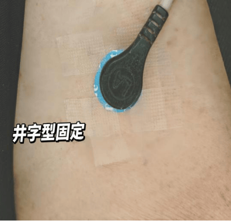 diy 奇招破解电极片过敏困境