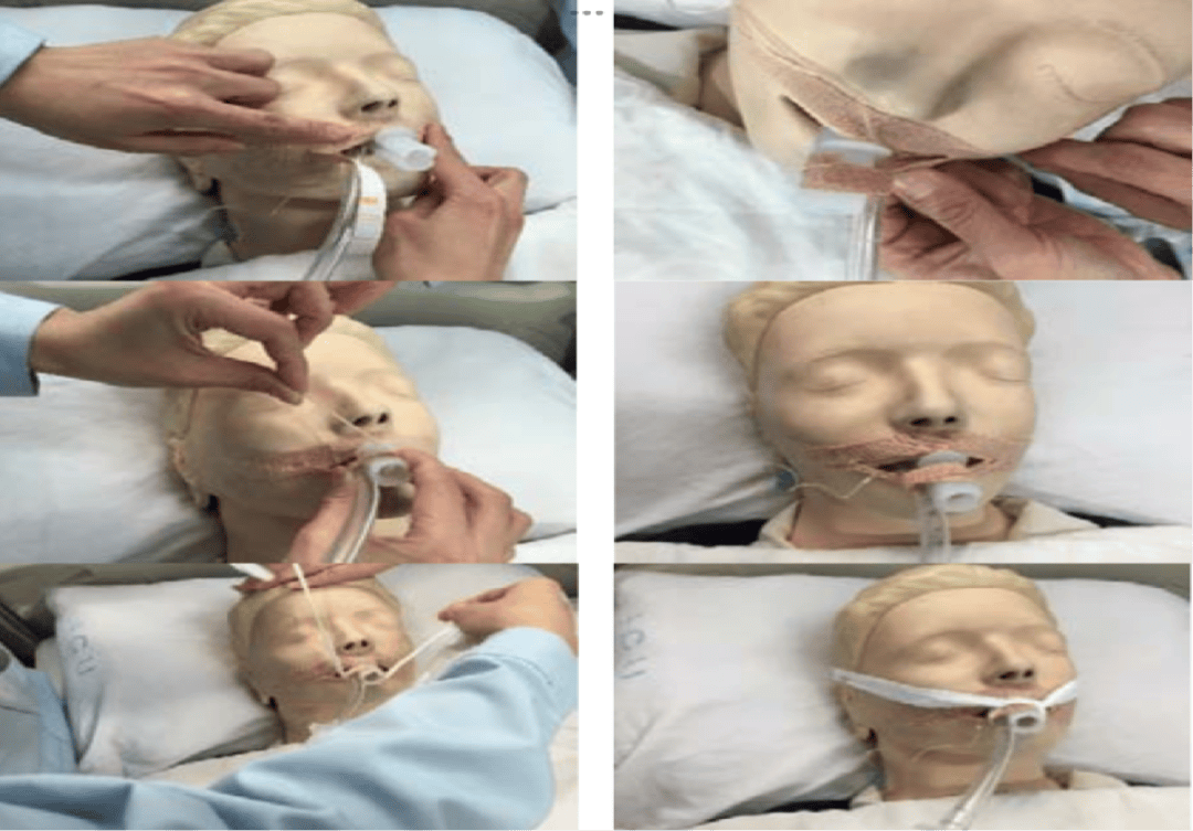 3种常见导管固定(t型,i型,y型法),护士你更青睐哪一种?