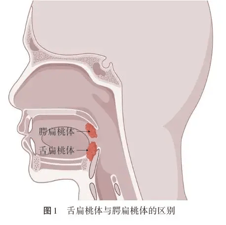 舌扁桃体肥大引起的困难气道管理:2例病例报道及文献总结