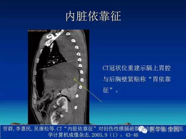 横膈征图片