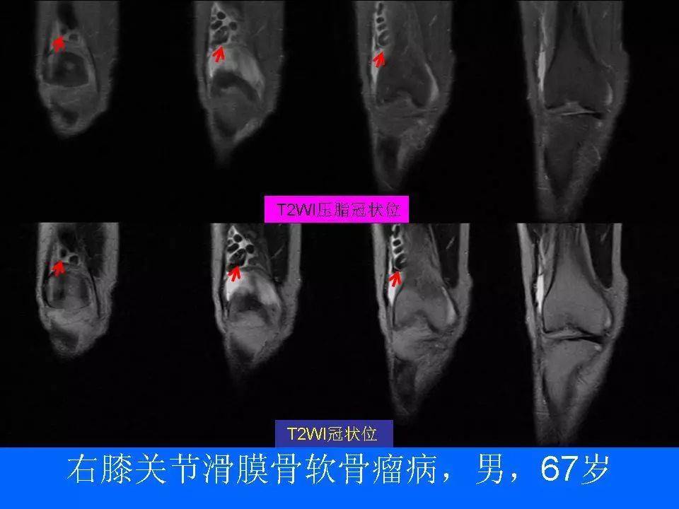 膝关节滑膜软骨瘤图片