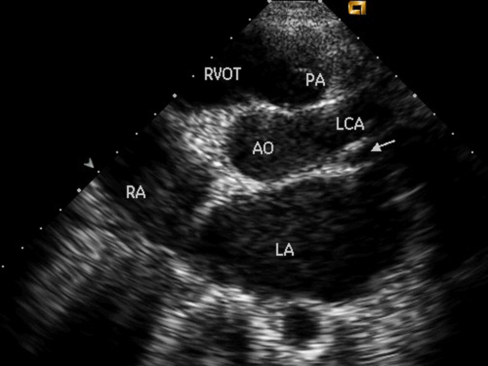 一文掌握:超声心动图必备基本功