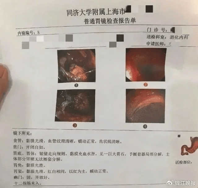 这些团块一旦形成,易阻塞肠道,导致肠梗阻的发生