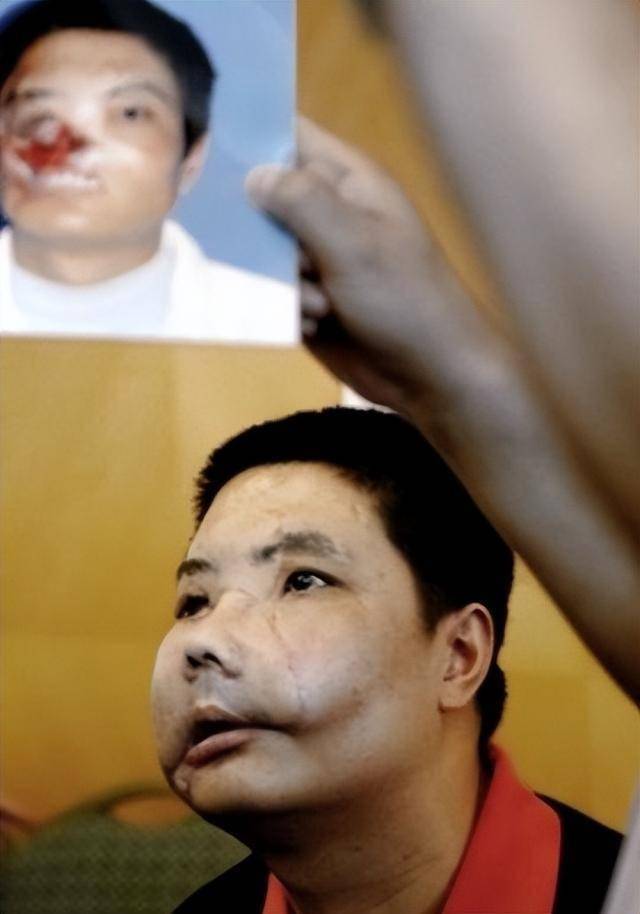 中国换脸第一人李国兴,不听医生劝告执意出院,半年后离奇死亡